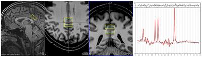 Richness in Functional Connectivity Depends on the Neuronal Integrity within the Posterior Cingulate Cortex